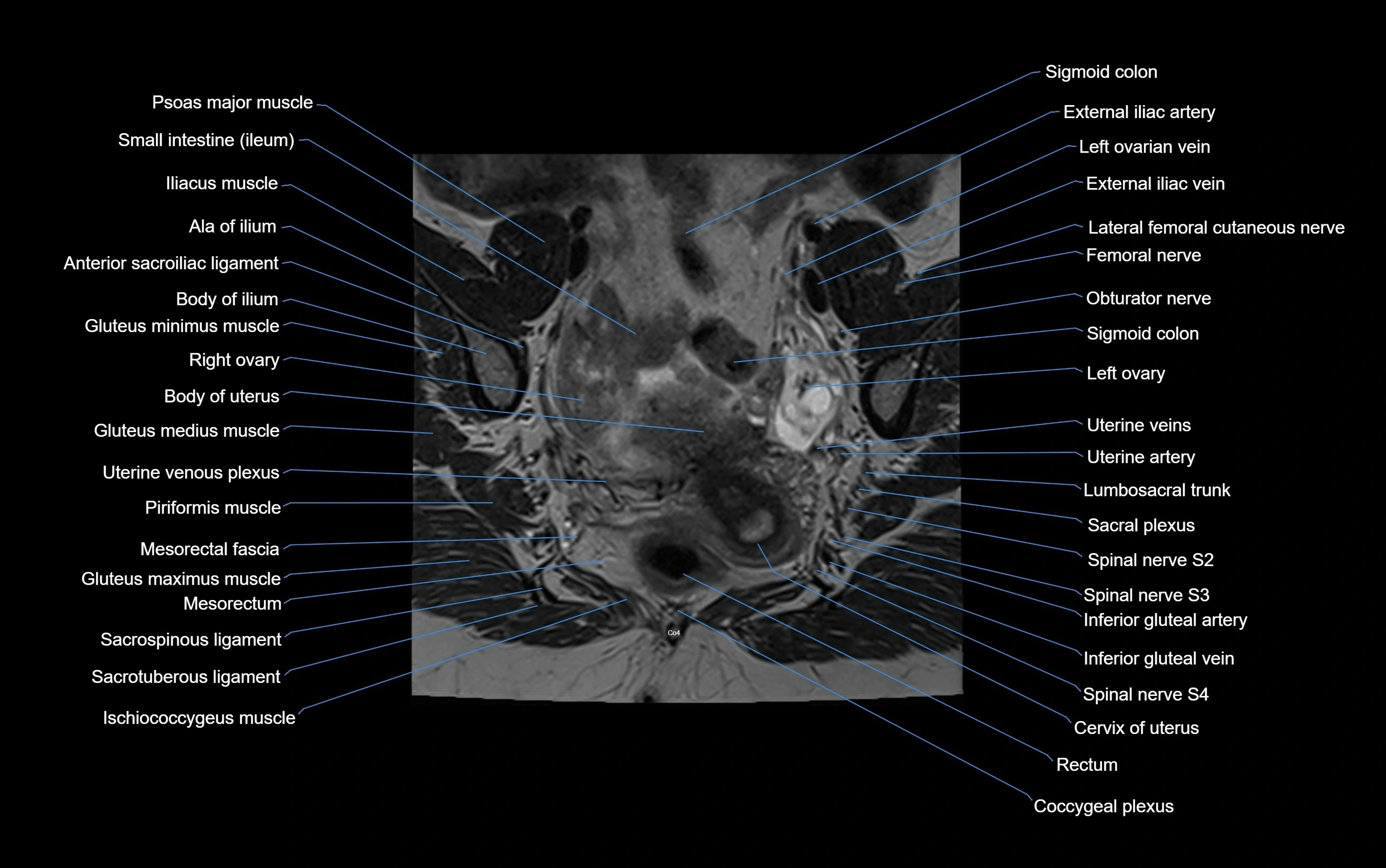 MRI sacroiliac joint coronal cross sectional anatomy  radiology  image-img-00001-00001.webp